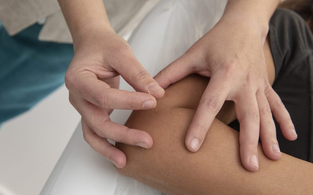 Acupuntura para Fibromialgia: Iniciativa Pioneira na Saúde Pública de Erechim